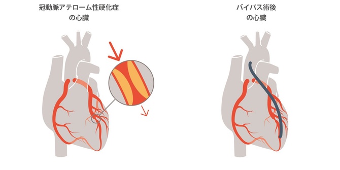 冠動脈アテローム性硬化症の心臓とバイパス術後の心臓